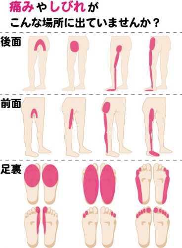 日常生活の天敵 坐骨神経痛 とは その症状と原因をご紹介 大阪の骨盤矯正専門ボディケアサロン 骨盤labo