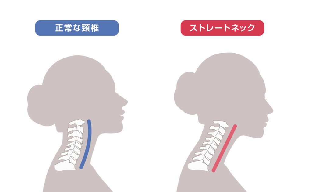 スマホ首・ストレートネックのイメージ