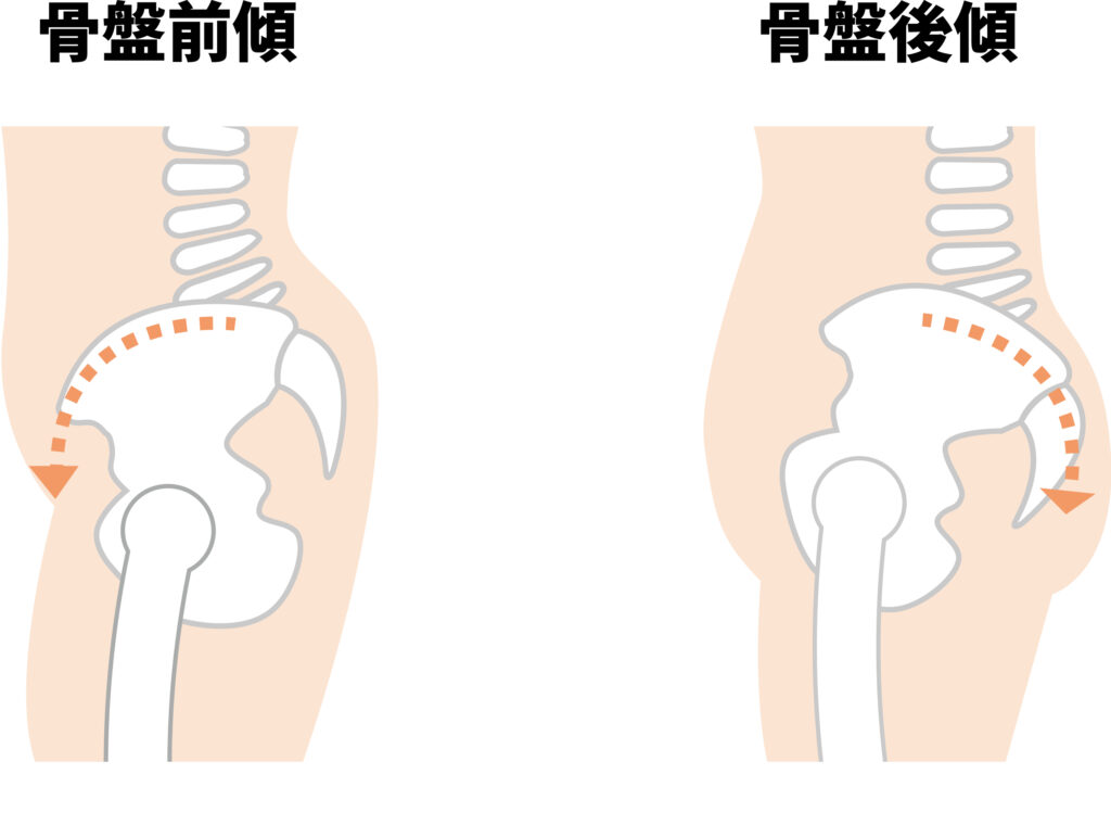  骨盤が後ろに倒れるタイプ（骨盤後傾型）のイメージ